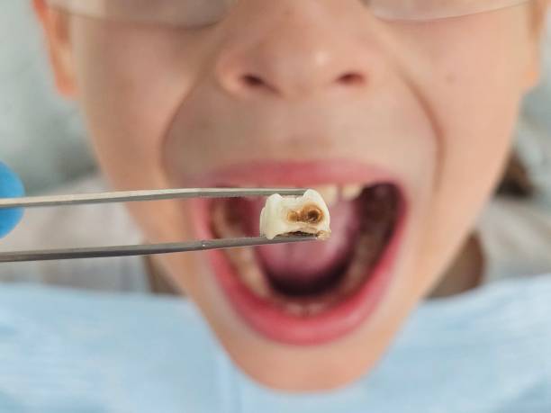 Best Emergency Root Canal Treatment in Inglis, FL
