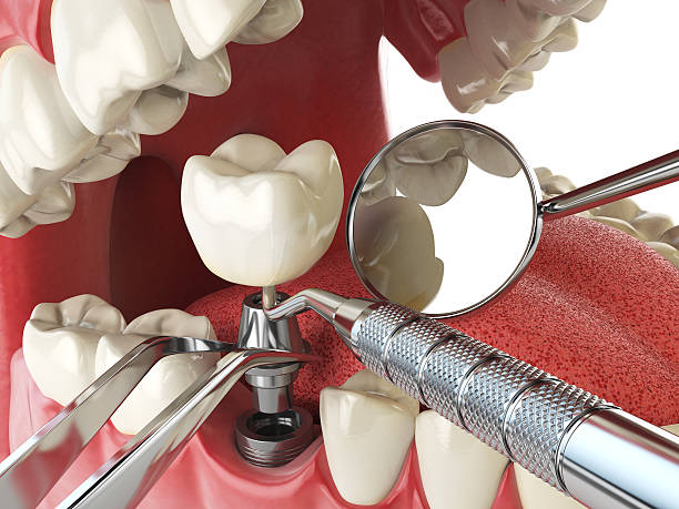 Best Emergency Tooth Extraction in Inglis, FL
